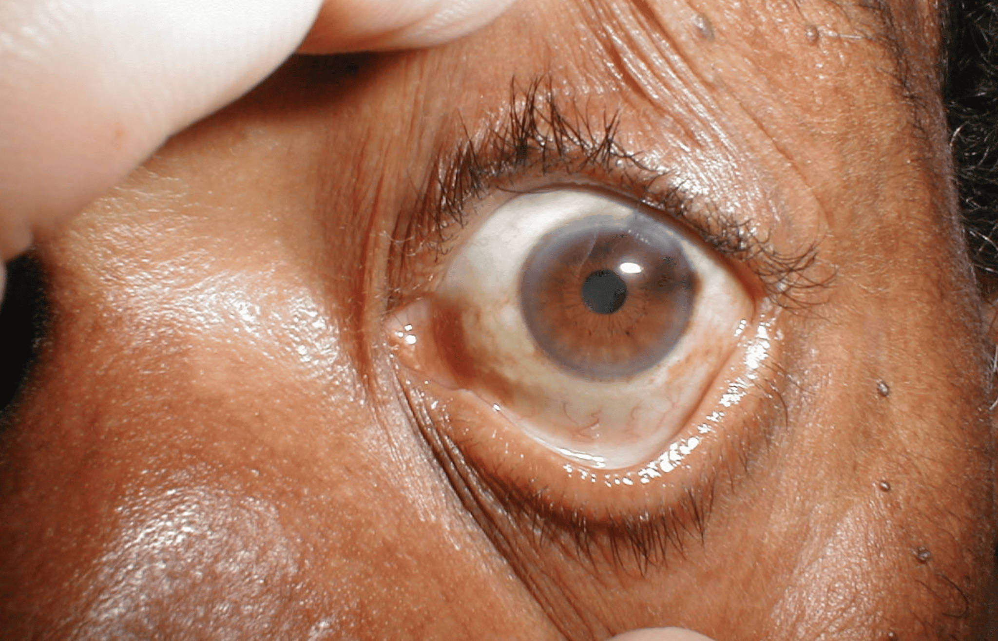 Eye Discoloration Why Does It Happen Ezinemark 