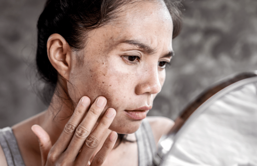 Skin Discoloration, What to Know