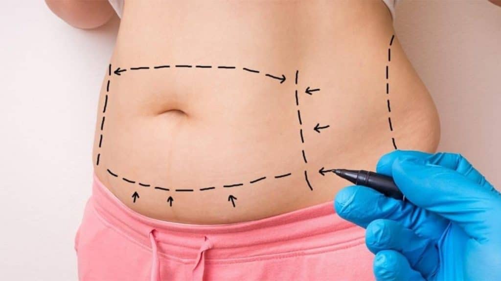 Tummy Tuck Safety and Affordability in Turkey Insights from Celyxmed