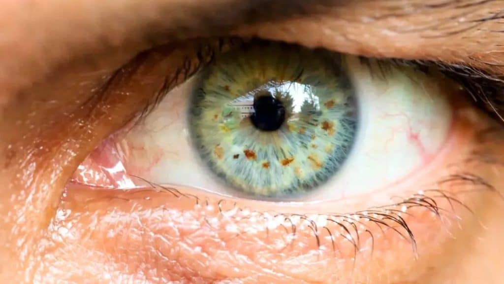 From Diagnosis to Treatment Managing Brown Spots in Your Eye