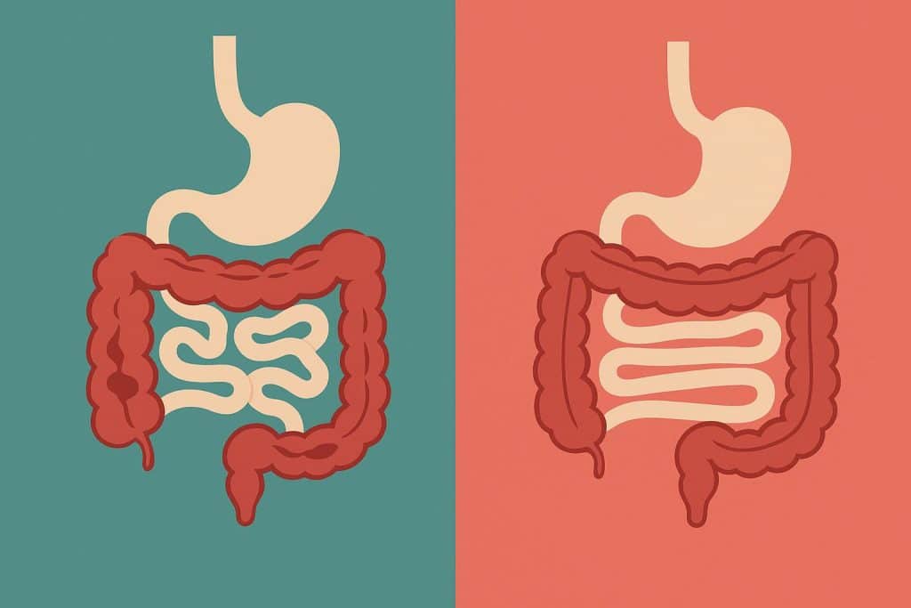 Differences Between Crohn’s & Ulcerative Colitis Illustration comparing digestive tract inflammation in Crohn’s disease and ulcerative colitis